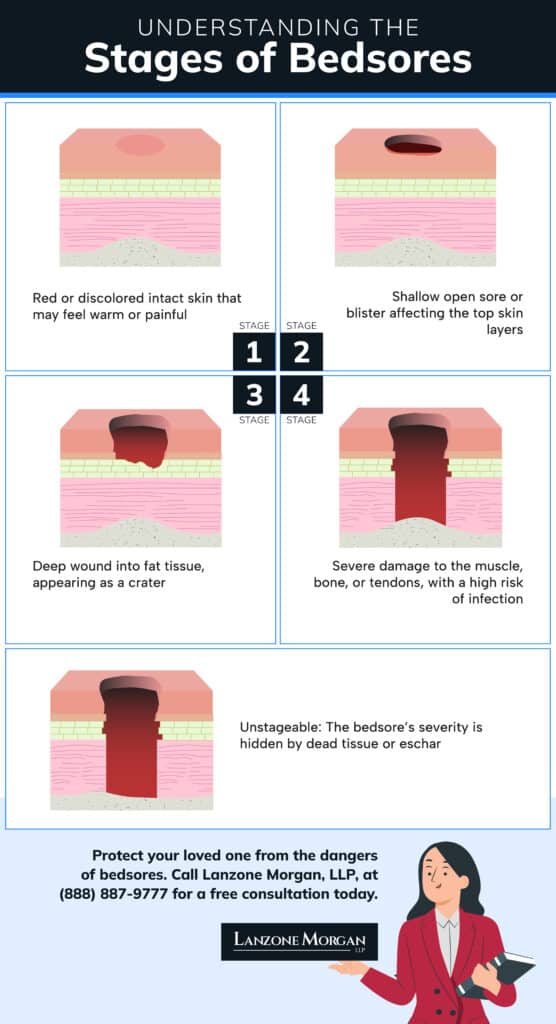 stages of bedsores infographic with stages 1-4 to unstageable